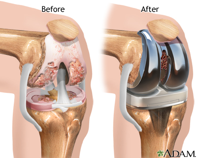 KNEE REPLACEMENT SURGERY