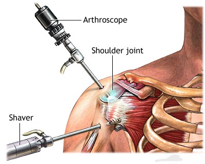 Is Arthroscopy Right for My Shoulder Pain? What You Need to Know